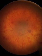 Retinal Hemorrhages
